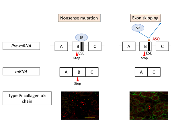 New Treatment Method For Alport Syndrome Uses Antisense 